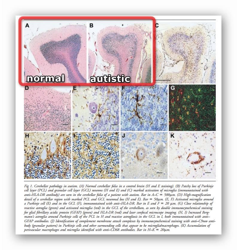 neuroinfiammazione