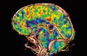 Regional cerebral blood flow in children with autism spectrum disorders: a quantitative 99mTc-ECD brain SPECT study with statistical parametric mapping evaluation