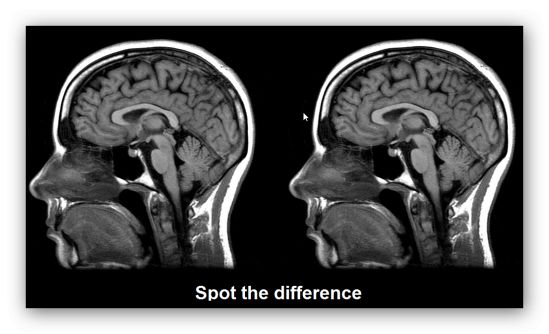Nessuna differenza fra cervello autistico e quello di soggetti normodotati