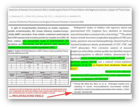 Evidenza di virus del morbillo nel liquor e nell&#039;intestino